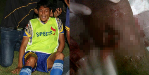 Kaki Iqbal Samad Berlubang Terkena Petasan Suporter Persisam Kaki Iqbal Samad Berlubang Terkena Petasan Suporter Persisam