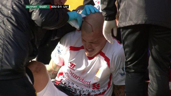 Video: Staf Medis Liverpool Tancapkan Staples ke Kepala Skrtel