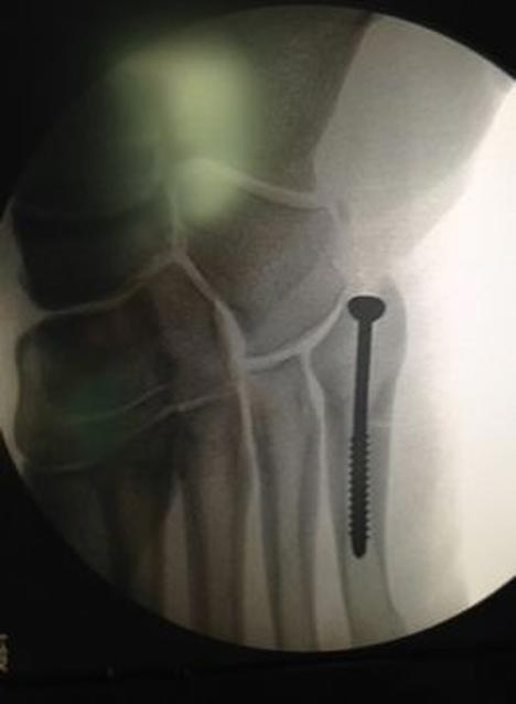 Skrup titanium di kaki Alonso. (c) AS