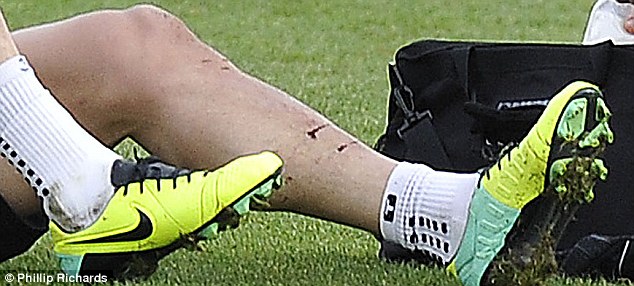 Foto sobekan di tulang kering Martin Skrtel