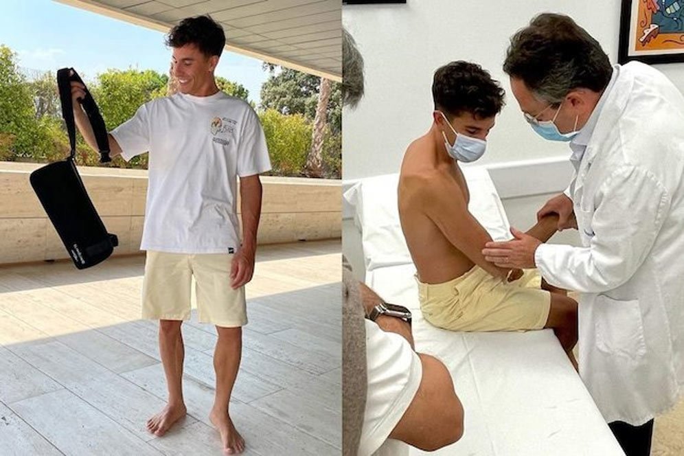 Marc Marquez sudah melepaskan gips lengan kanannya enam pekan usai operasi. (c) X/MarcMarquez93