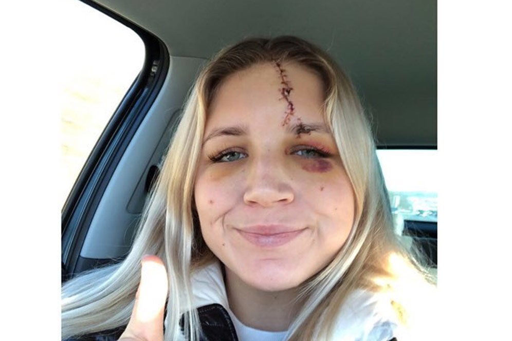 Brutal! Kiper Liverpool Wanita Ini Alami Cedera Robekan di Kepala yang Mengerikan Brutal! Kiper Liverpool Wanita Ini Alami Cedera Robekan di Kepala yang Mengerikan