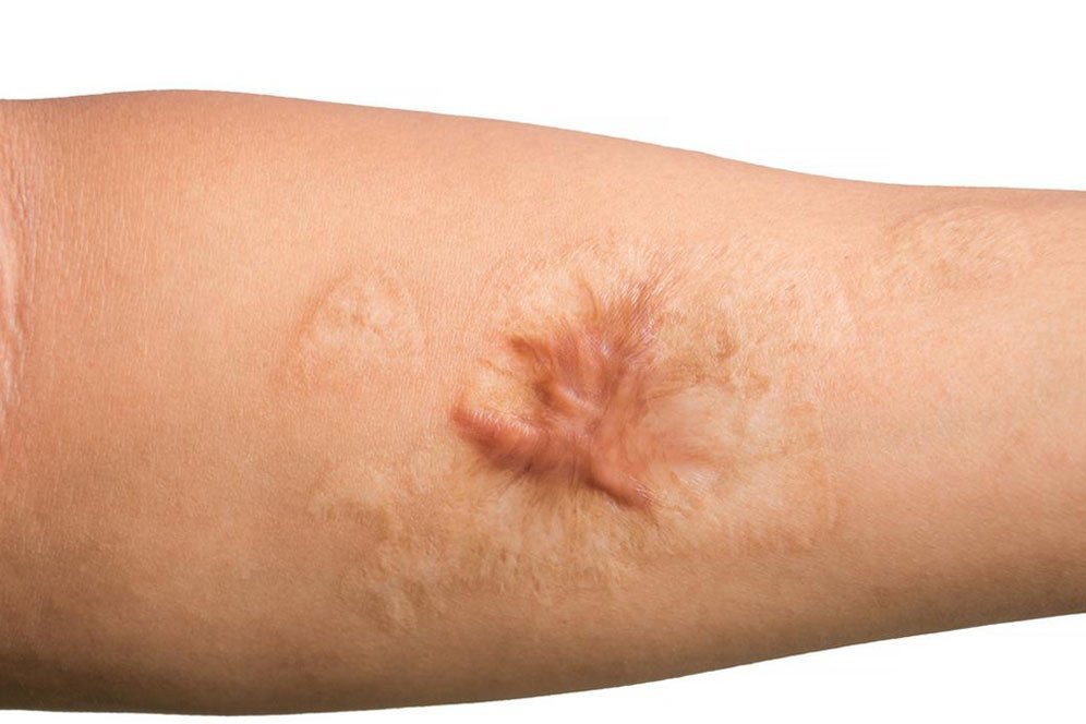 Pahami Cara Mengobati Keloid, Waspadai Pula Efek Sampingnya Pahami Cara Mengobati Keloid, Waspadai Pula Efek Sampingnya