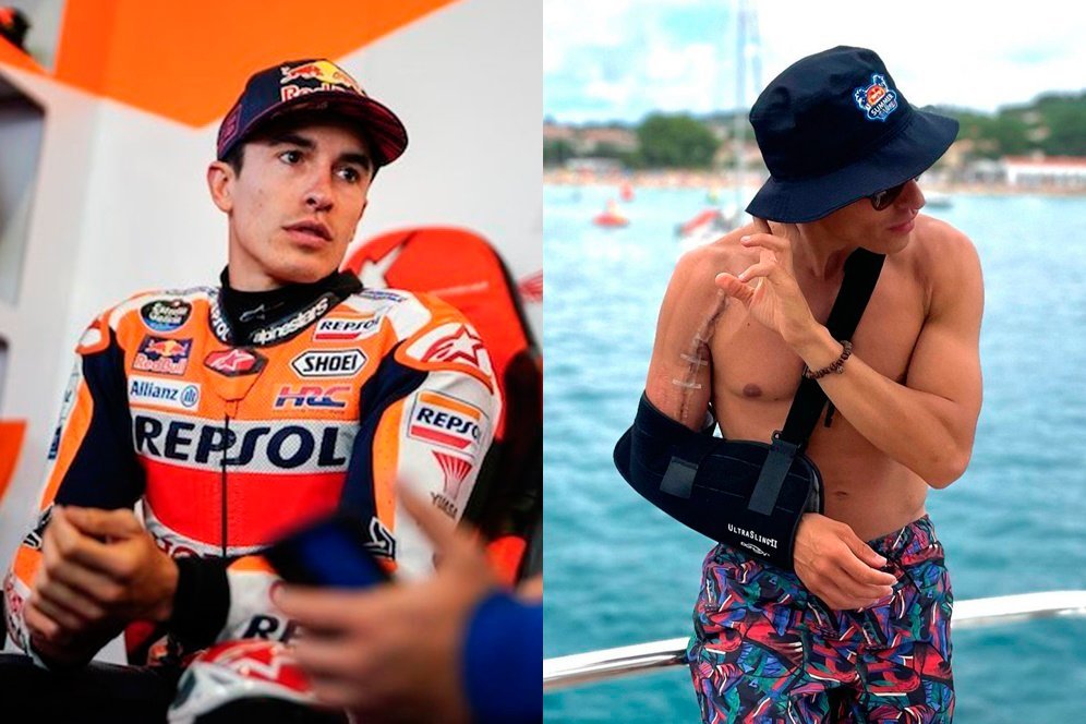 Marc Marquez: Dioperasi 4 Kali, Lengan Kanan Saya Jelas Takkan Normal Lagi Marc Marquez: Dioperasi 4 Kali, Lengan Kanan Saya Jelas Takkan Normal Lagi
