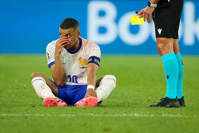 Hidung Kylian Mbappe Patah